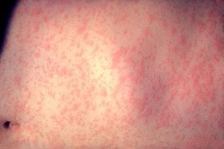 Skin 3 days after Measles Infection